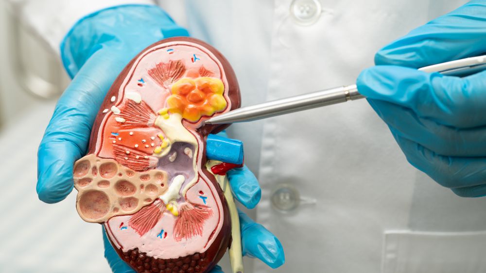 Kidney cross-section showing damaged glomeruli